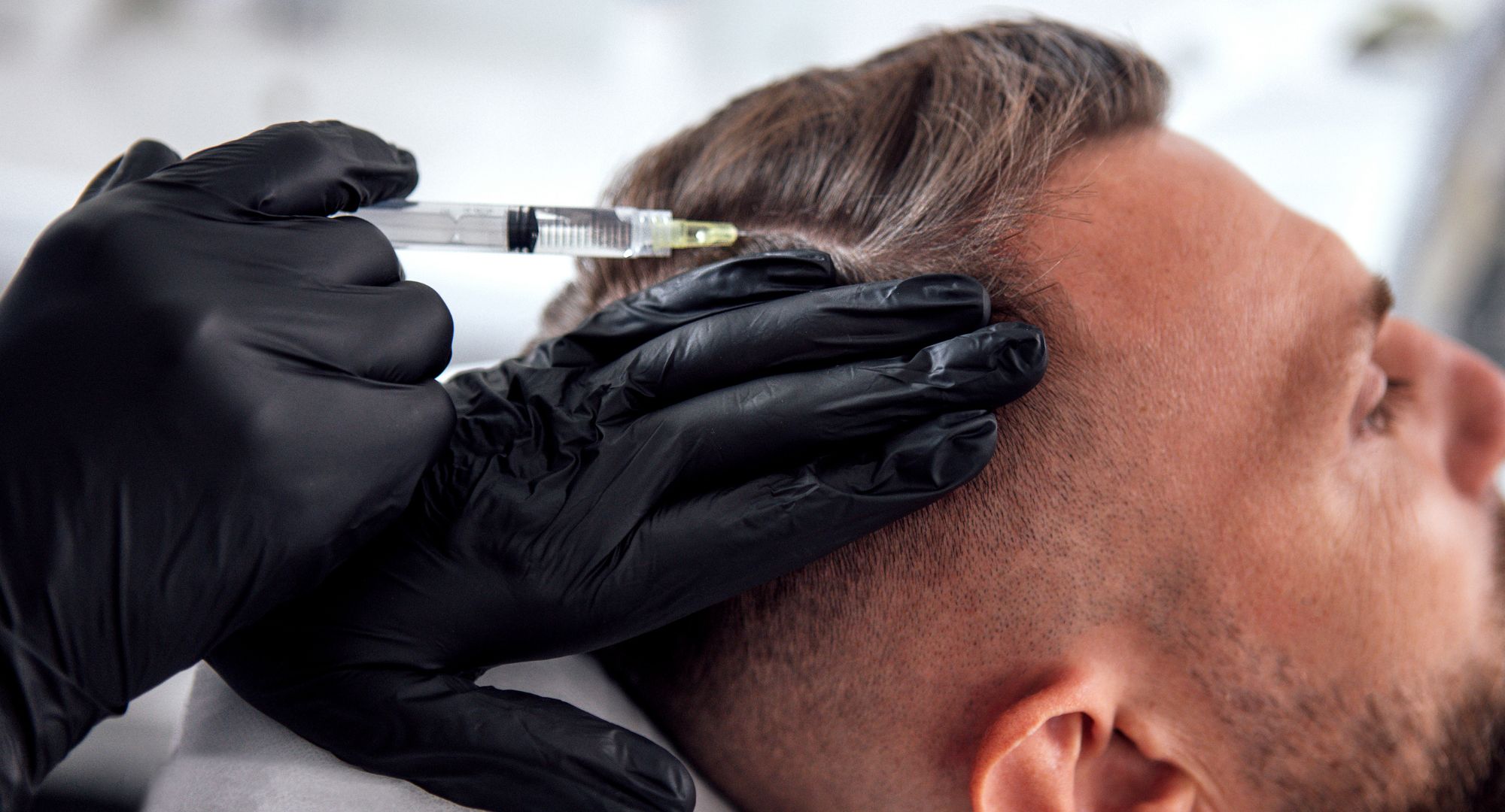 Procedimiento de mesoterapia capilar