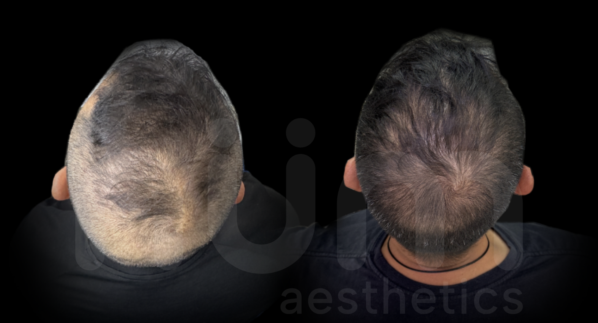 Resultados de mesoterapia capilar
