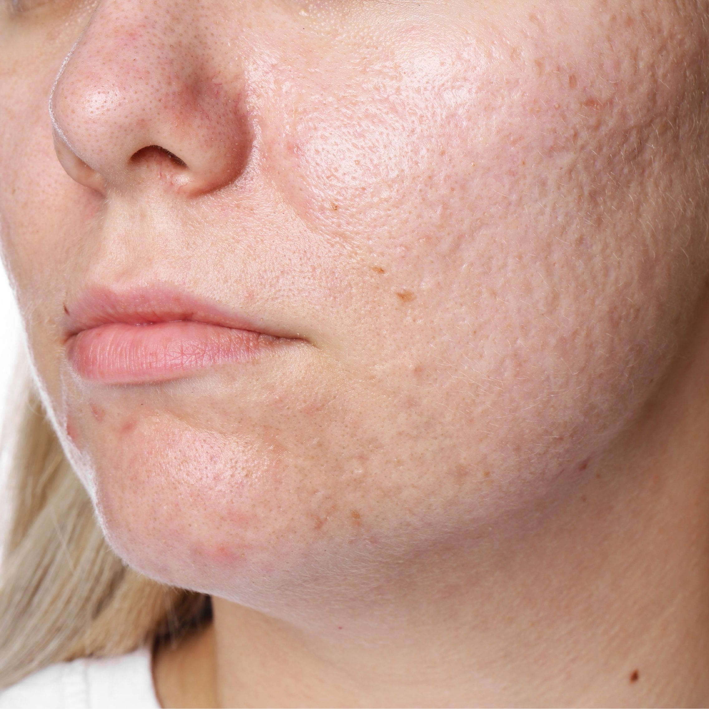 Mesoterapia Facial Cicatrices — Clínica NÜM