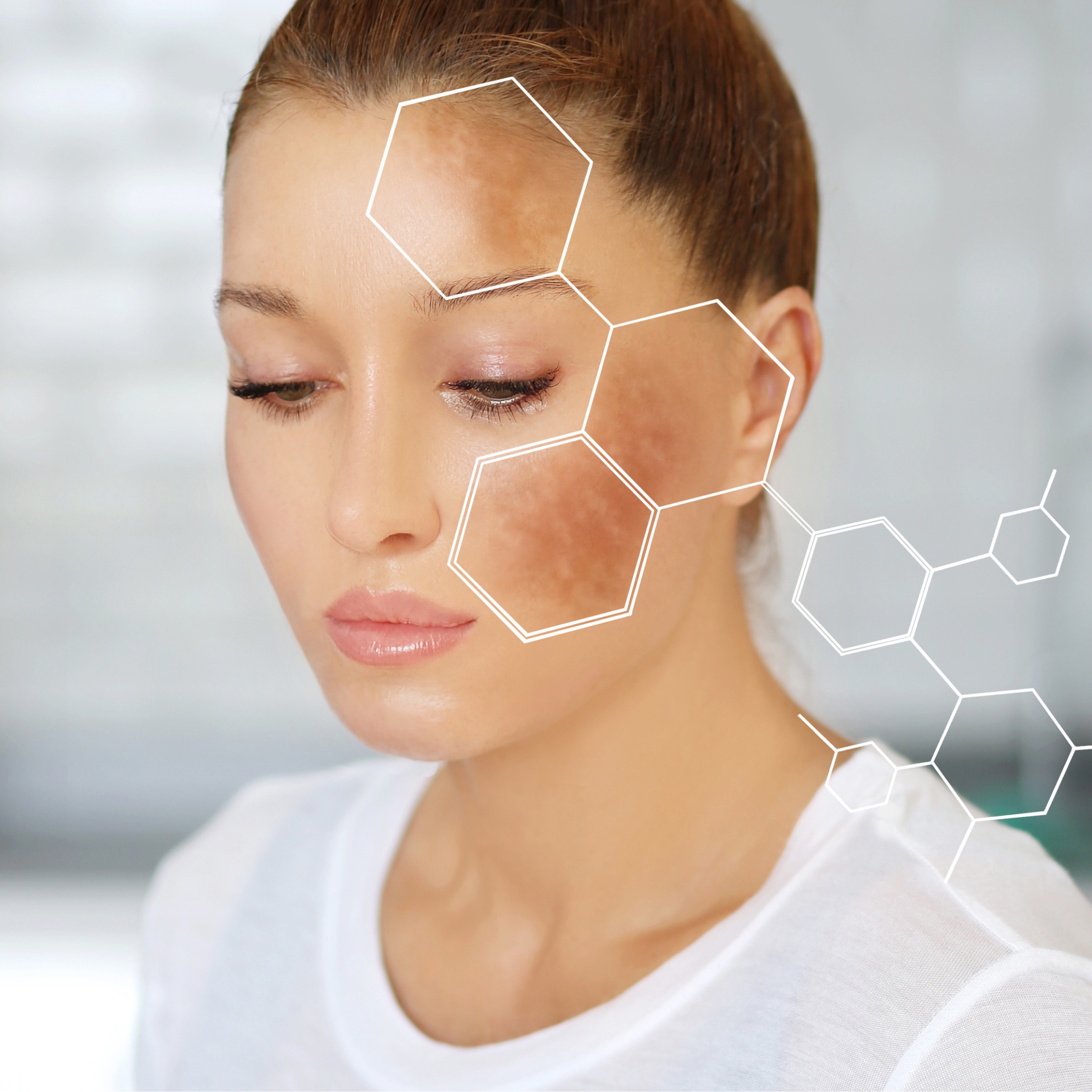 Mesoterapia Facial Despigmentante