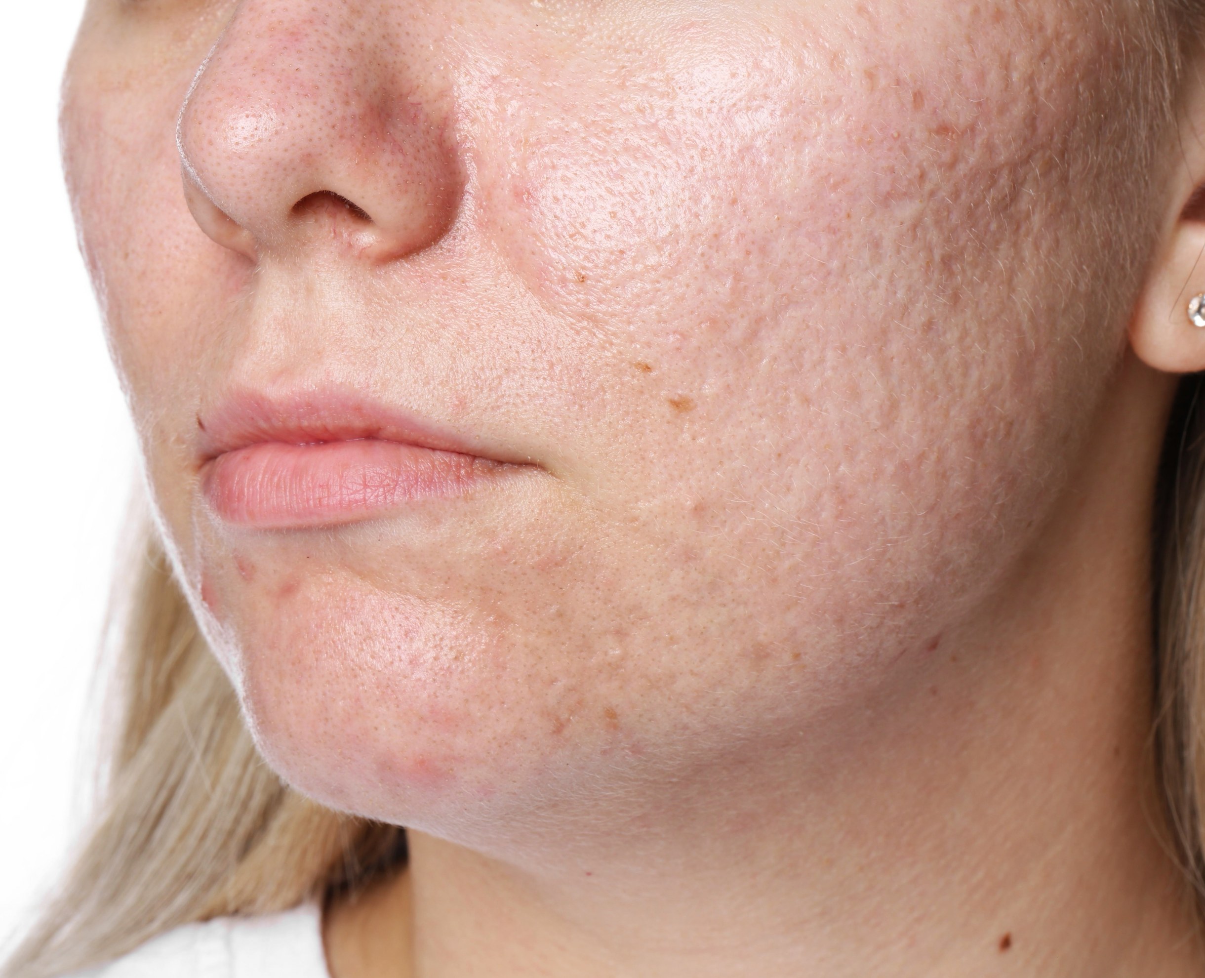 Mesoterapia Facial para Cicatrices