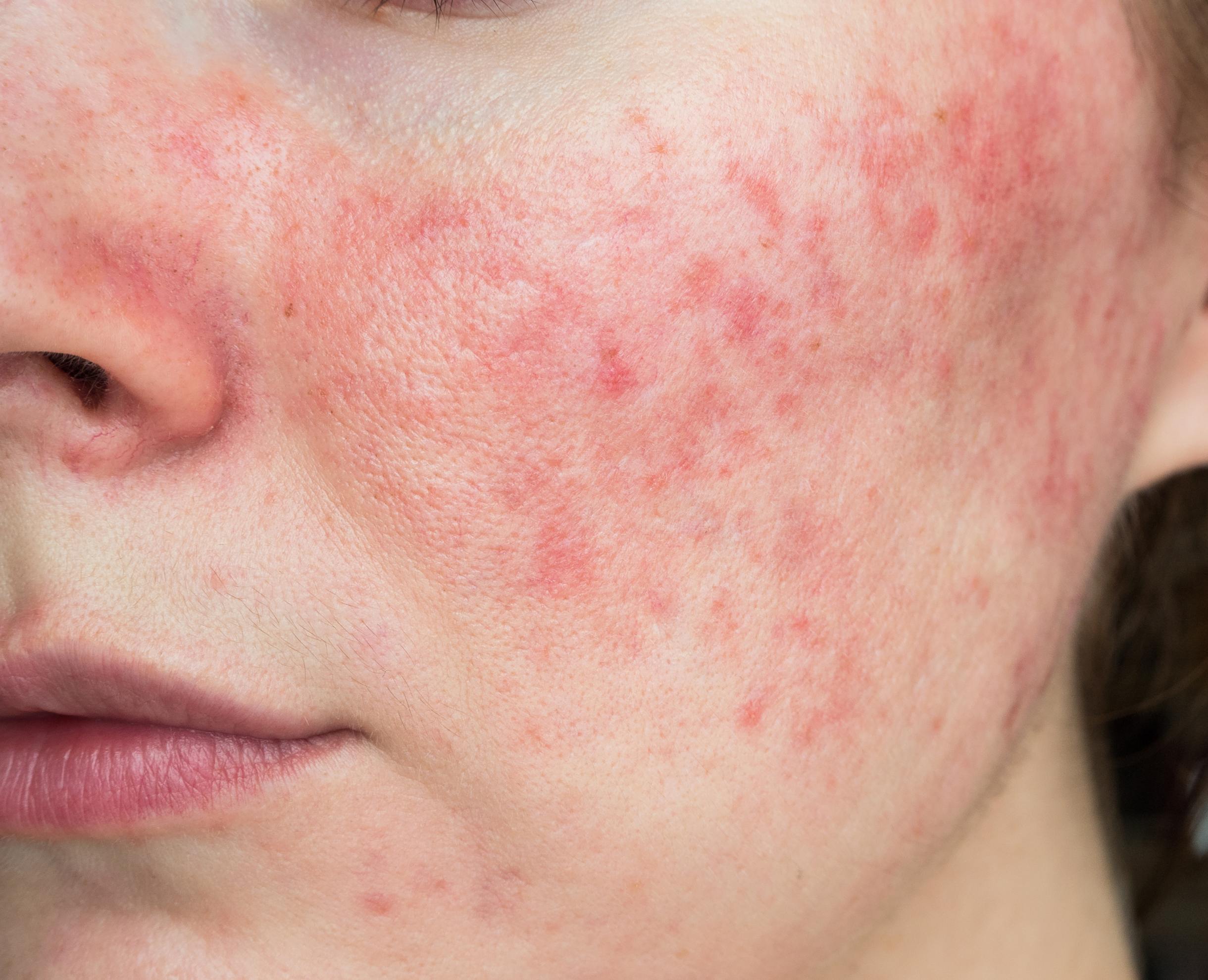 Mesoterapia Facial para Piel con Tendencia al Enrojecimiento
