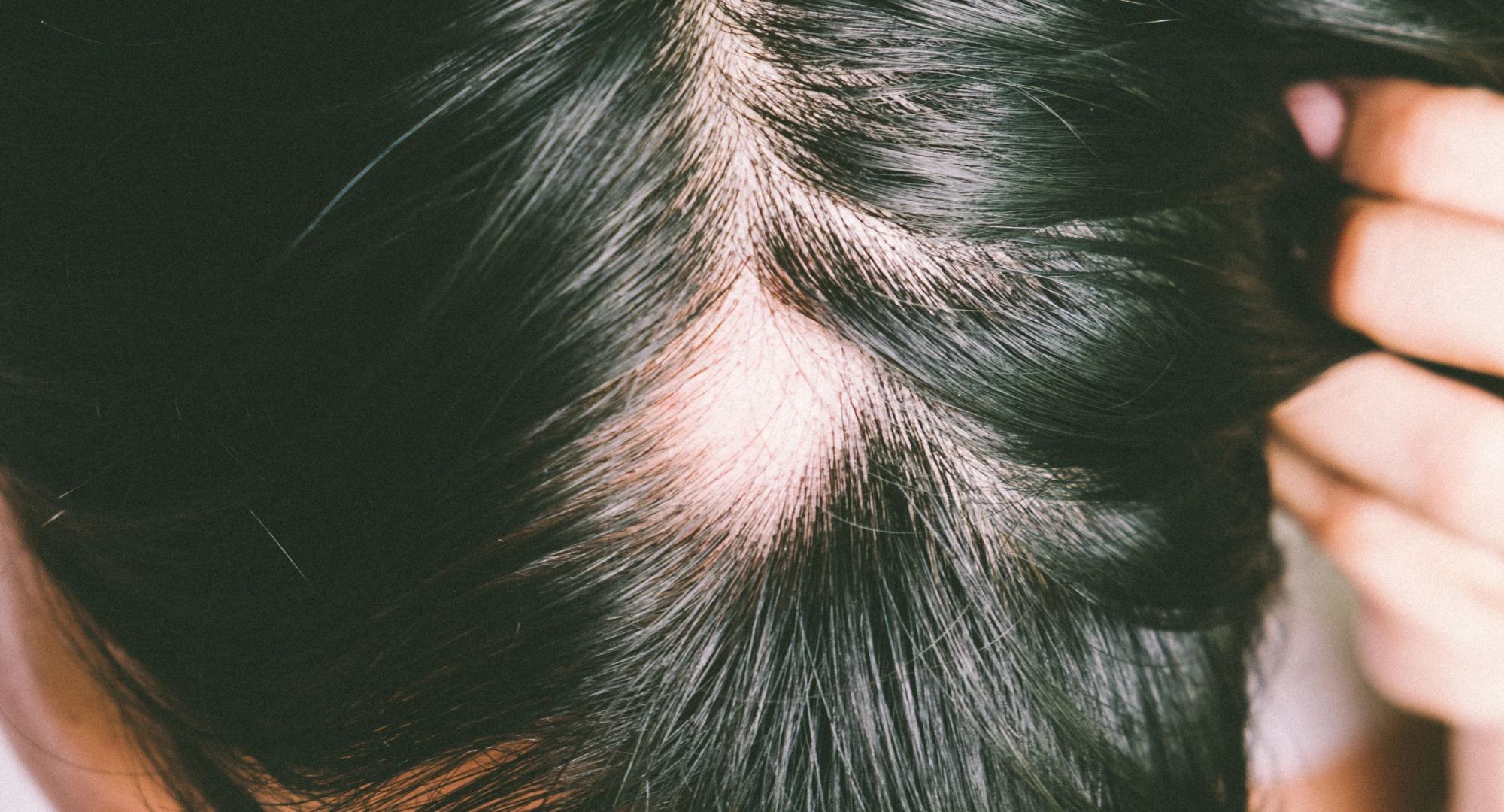 Mesoterapia con Triamcinolona