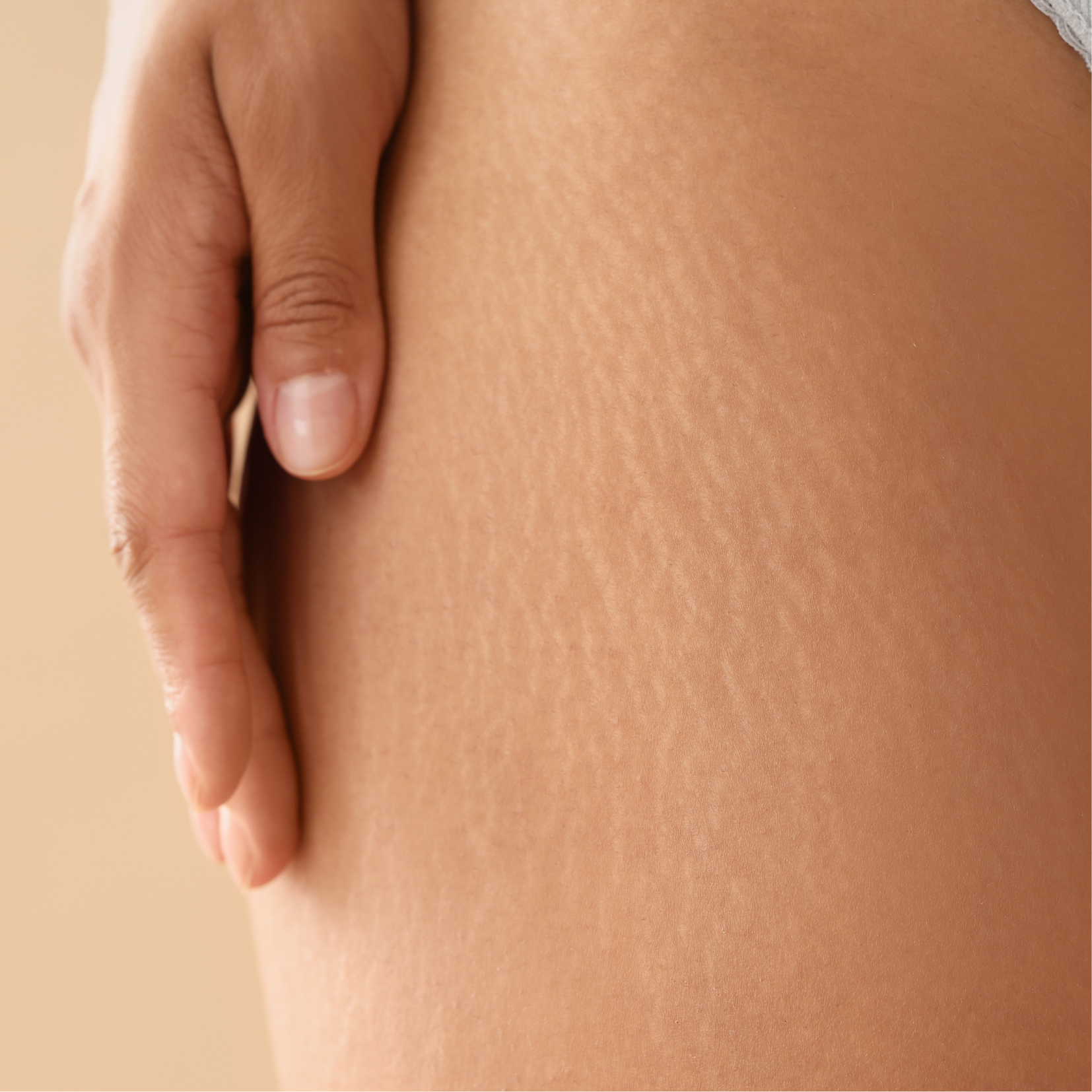 Mesoterapia Estrías y Cicatrices