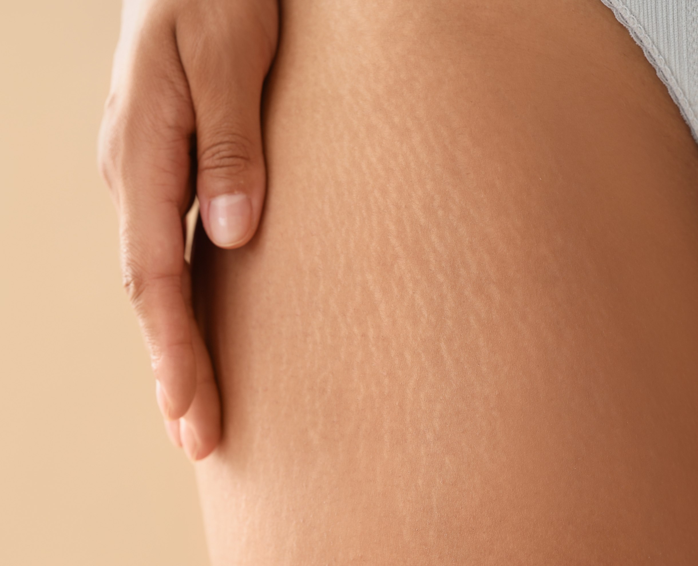 Mesoterapia Corporal para Estrías y Cicatrices