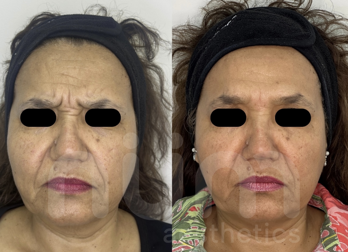 Resultados de tratamiento con bótox
