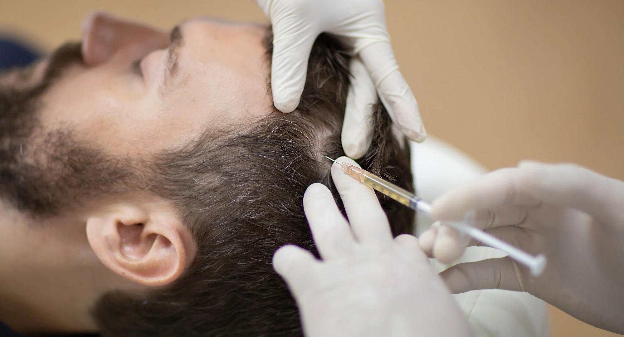 Plasma rico en plaquetas PRP para caída de cabello