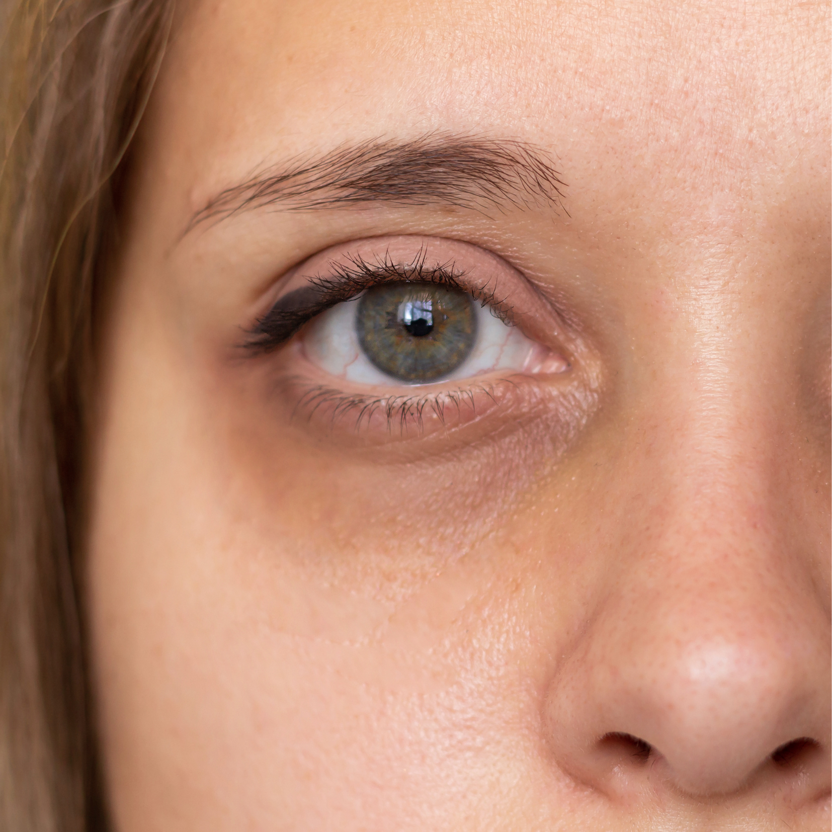 Relleno de Ojeras