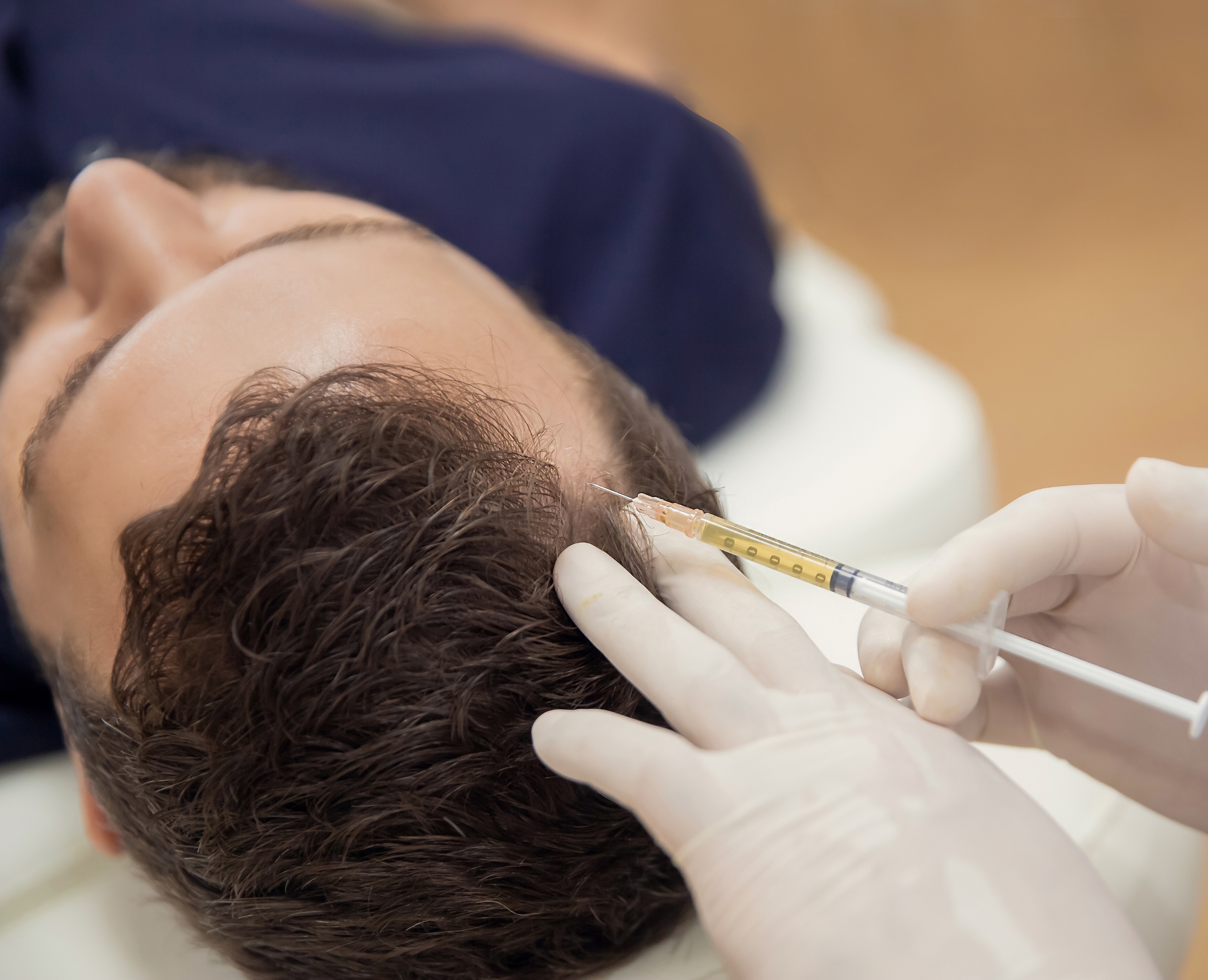 Procedimiento de Inyección Capilar - Medicina Capilar Profesional