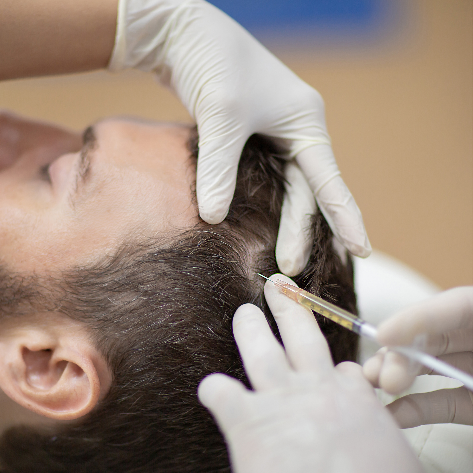 Tratamiento Capilar con PRP — Clínica NÜM