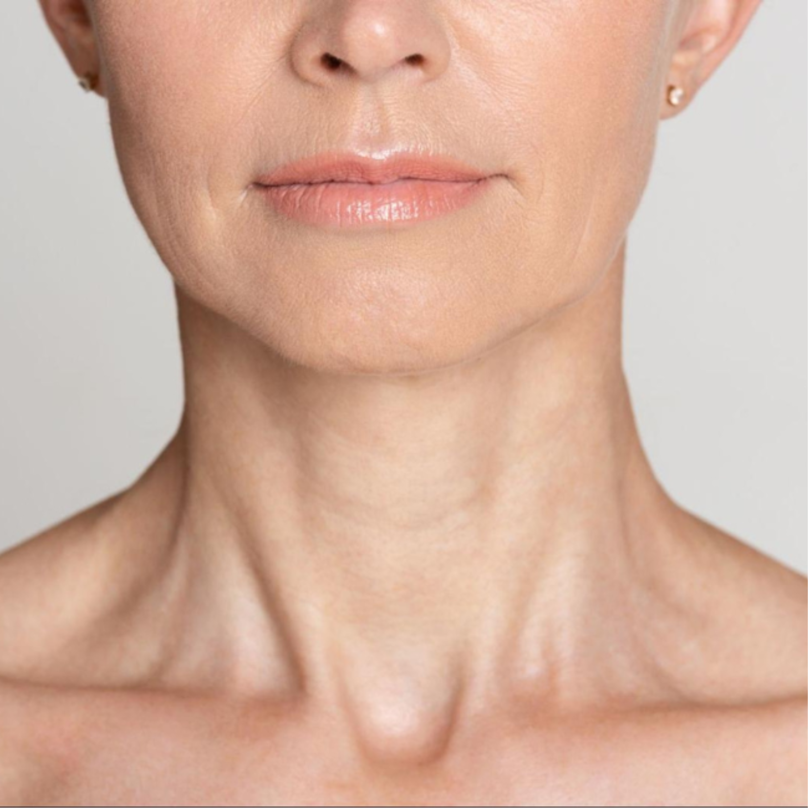 Toxina Botulínica para Cuello — Clínica NÜM