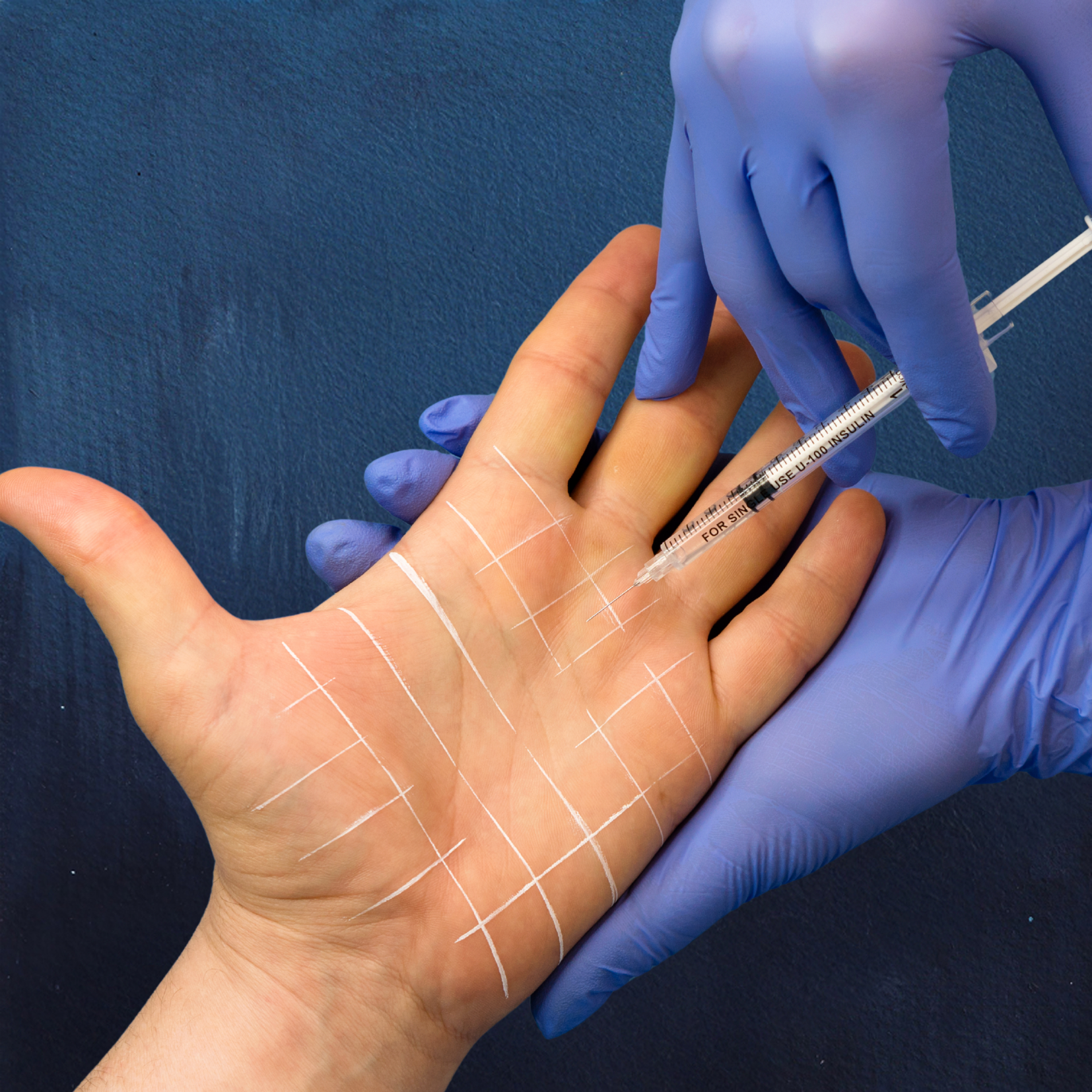 Toxina Botulínica para Hiperhidrosis — Clínica NÜM
