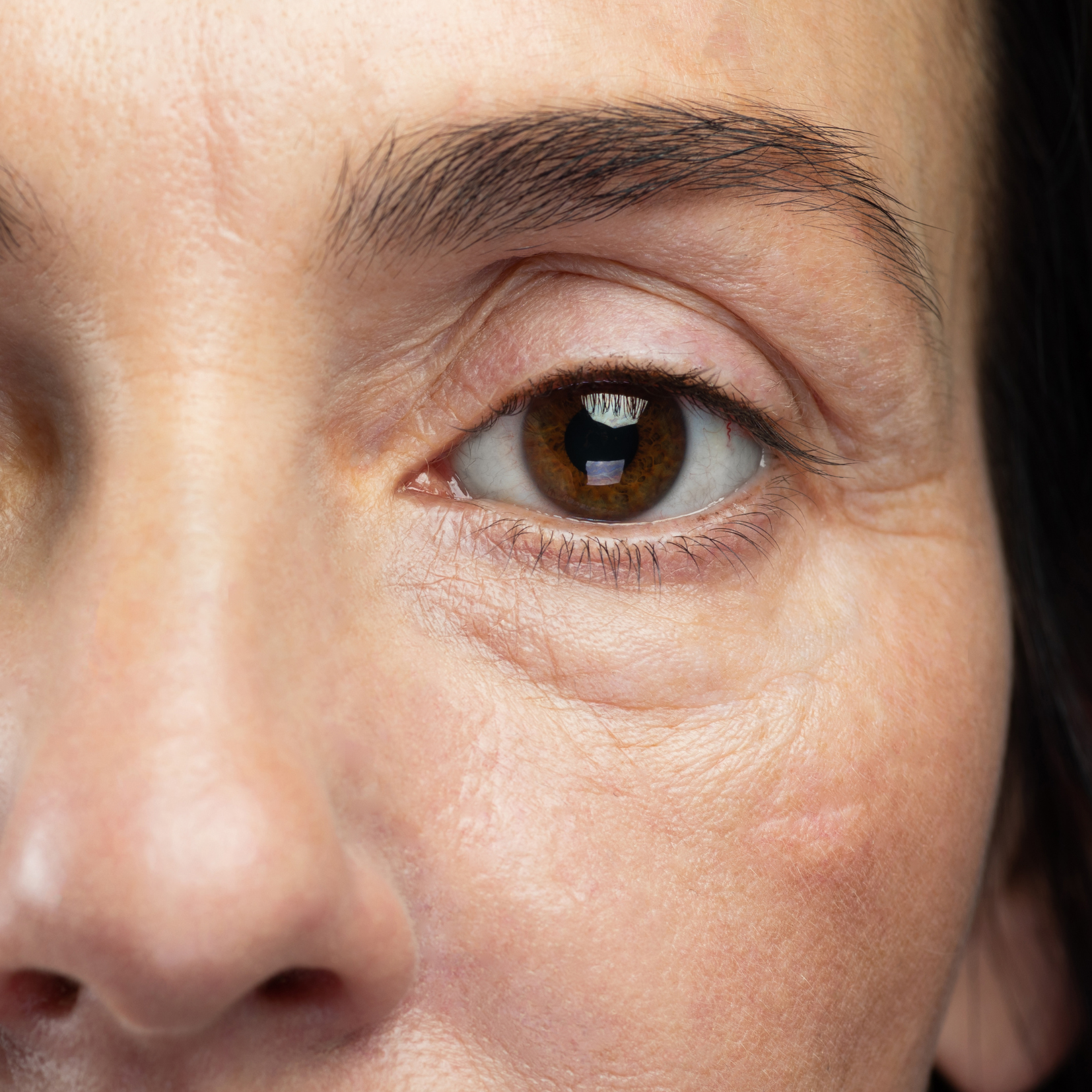 Tratamiento de Ojeras con Enzimas Recombinantes — Clínica NÜM
