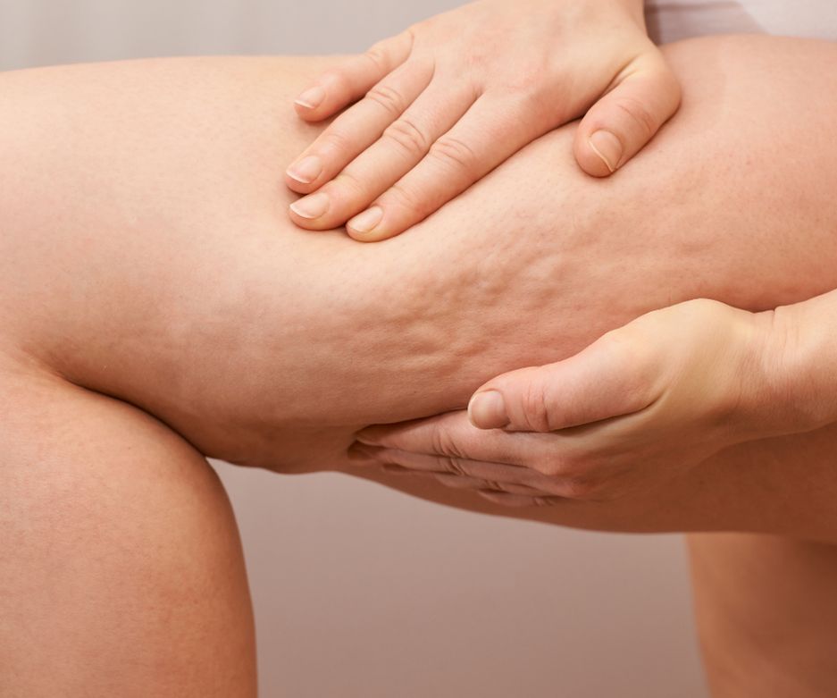 Tratamiento para Celulitis con ALIDYA™