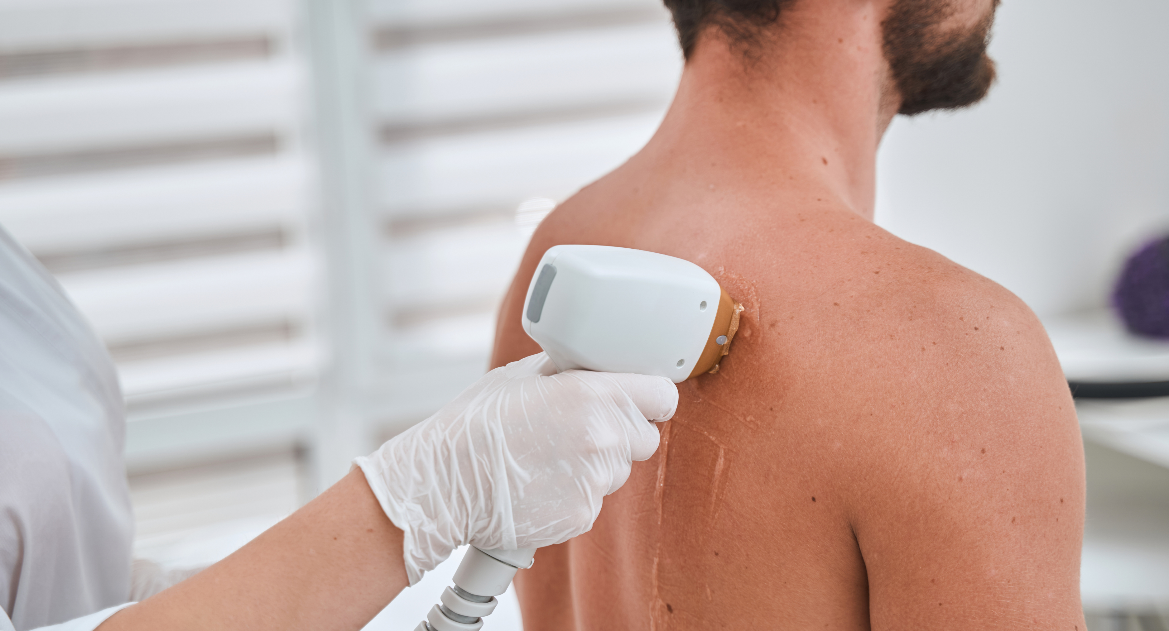 Depilación Láser Masculina — Cuerpo Superior