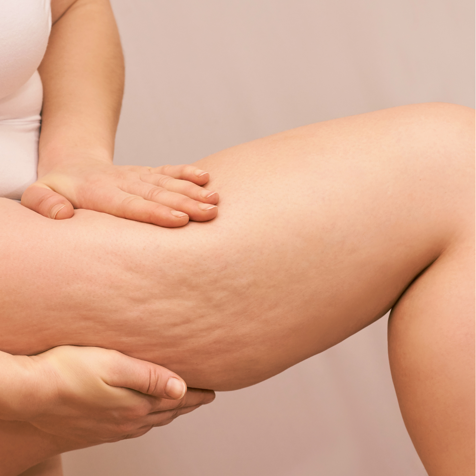 Tratamiento PEFE Celulitis con Enzimas