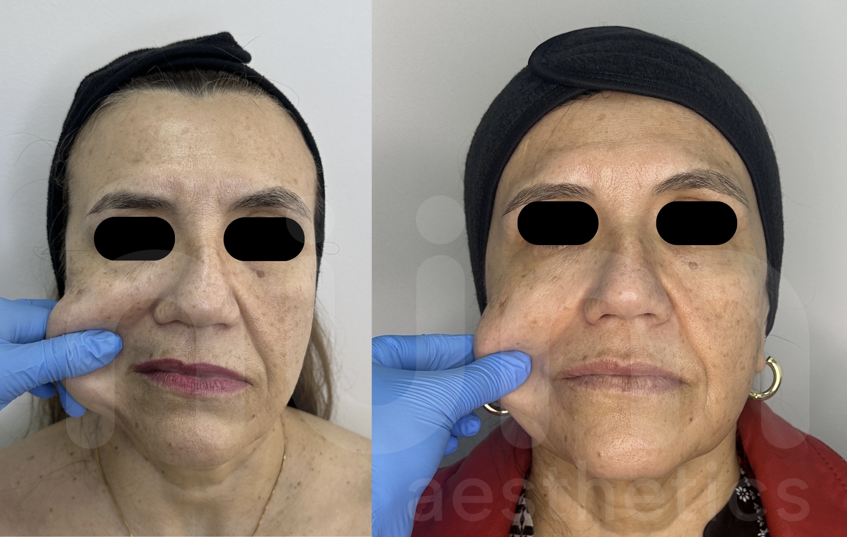 Tratamientos complementarios a Sculptra